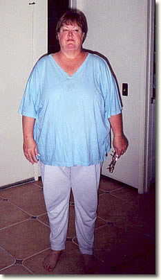 Claire Before Weight Loss Surgery