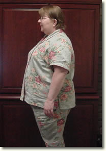 Eulema Before Gastric Bypass Surgery