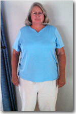 Weight Loss Surgery Patient Before and After